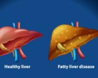  ਫੈਟੀ ਲੀਵਰ ਦੀ ਸਮੱਸਿਆ ਅੱਜ-ਕੱਲ੍ਹ ਗਲਤ ਖਾਣ-ਪੀਣ ਅਤੇ ਸੁਸਤ ਜੀਵਨ ਸ਼ੈਲੀ ਕਾਰਨ ਕਾਫ਼ੀ ਵਧ ਰਹੀ ਹੈ