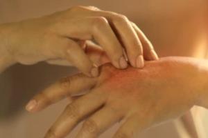 ਸਰਦੀਆਂ ਵਿੱਚ ਇਹਨਾਂ ਚਮੜੀ ਰੋਗਾਂ ਦਾ ਖ਼ਤਰਾ ਸਭ ਤੋਂ ਵੱਧ ਹੁੰਦਾ ਹੈ,ਇਹਨਾਂ ਨੂੰ ਕਿਵੇਂ ਰੋਕਿਆ ਜਾਵੇ