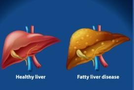 ਫੈਟੀ ਲੀਵਰ ਦੀ ਸਮੱਸਿਆ ਅੱਜ-ਕੱਲ੍ਹ ਗਲਤ ਖਾਣ-ਪੀਣ ਅਤੇ ਸੁਸਤ ਜੀਵਨ ਸ਼ੈਲੀ ਕਾਰਨ ਕਾਫ਼ੀ ਵਧ ਰਹੀ ਹੈ